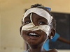 Podvyivené somálské dít se po vyerpávajícím pochodu dokalo zdravotního oetení v keském Dadaabu, kde je uprchlický tábor 