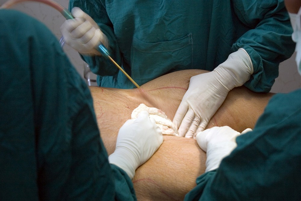 Liposukce (ilustra�ní foto)