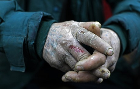 Mrazy ohrožují především lidi bez domova, na fotce omrzlé ruce bezdomovce v Bukurešti.