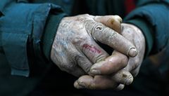 Mrazy ohroují pedevím lidi bez domova, na fotce omrzlé ruce bezdomovce v Bukureti.