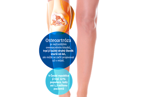artróza kolene 3 stupně invalidity
