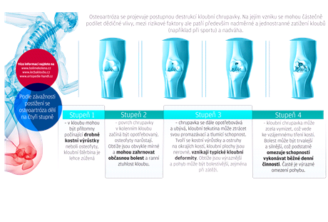 Hogyan és hogyan lehet eltávolítani a lábak duzzanatát a térd artrózisában