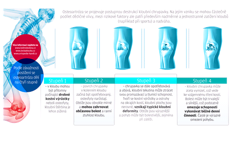 jak na artrózu