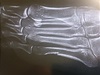 Kowalczyková zveejnila na facebooku rentgen své zlomeniny