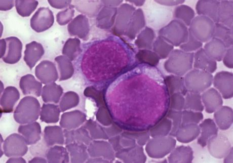 Buňky zasažené leukémií, jak byly představeny ve vědeckém časopise PLoS.