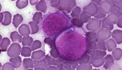 Buňky zasažené leukémií, jak byly představeny ve vědeckém časopise PLoS.