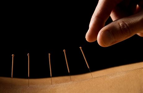 Akupunktura (ilustraní foto)