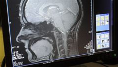 Co se děje s mozkem během nemoci? Nové přístroje vědcům v Brně pomohou