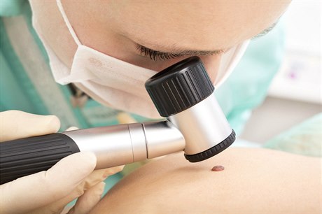 Podle prognóz lékařů letos přibyde 2525 diagnóz zhoubného melanomu.
