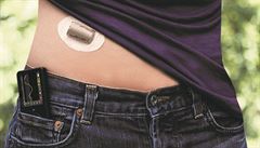 Sensor pomáhá v boji s cukrovkou. Vyjde ale na desítky tisíc ročně