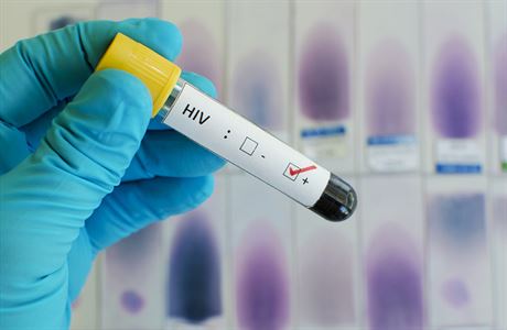 Verdikt: HIV pozitivní. Pokud se úspch izraelských vdc potvrdí, nabídne...