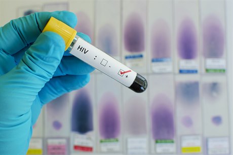 HIV testy (ilustrační foto)