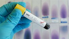 Na Slovensku rekordně přibývá nakažených virem HIV, jejich počty rostou i v Česku