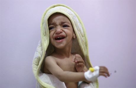 Podvyiven chlapec ple na jednotce intenzivn pe v nemocnici v San.