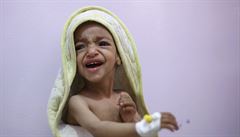 Podvyivený chlapec pláe na jednotce intenzivní pée v nemocnici v Saná.