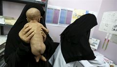Jemenská matka drí v náruí své podvyivené miminko v lékaské ordinaci v Saná.