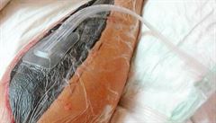Takto vypadala pravá noha Katky Bogliové po operaci