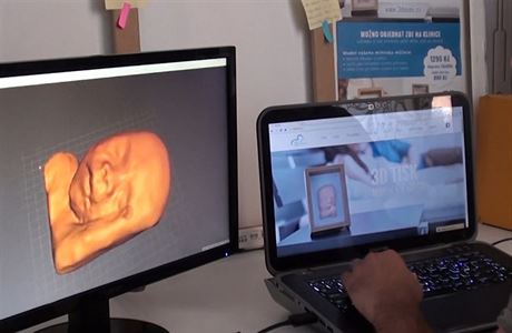 Díky 3D ultrazvuku je moné vymodelovat plastiku nenarozeného dítte.