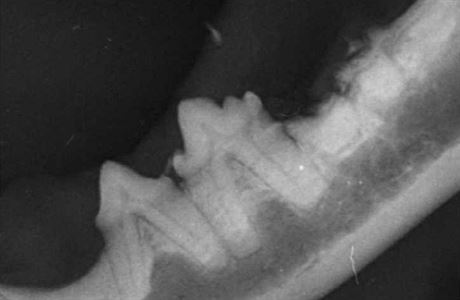 Zlomenina korunky zubu se subgingivln (pod rovn dsn) lokalizovanmi...