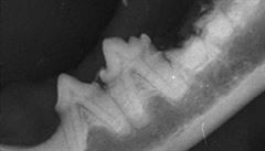Zlomenina korunky zubu se subgingiváln (pod úrovní dásn) lokalizovanými...
