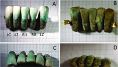 Pevratný nález. V Itálii nali zubní protézu starou tyi století