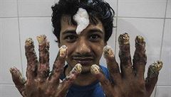 ‚Stromový muž‘ z Bangladéše se po operaci bradavic uzdravuje