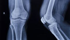 Voperovaný implantát podpoří růst nové chrupavky v koleni 