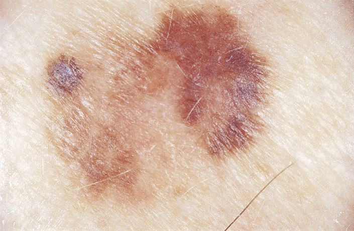 Jak dlouho se dá žít s melanomem?