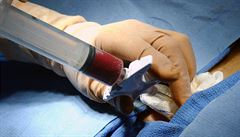 Čeští lékaři provedli tisící transplantaci kostní dřeně