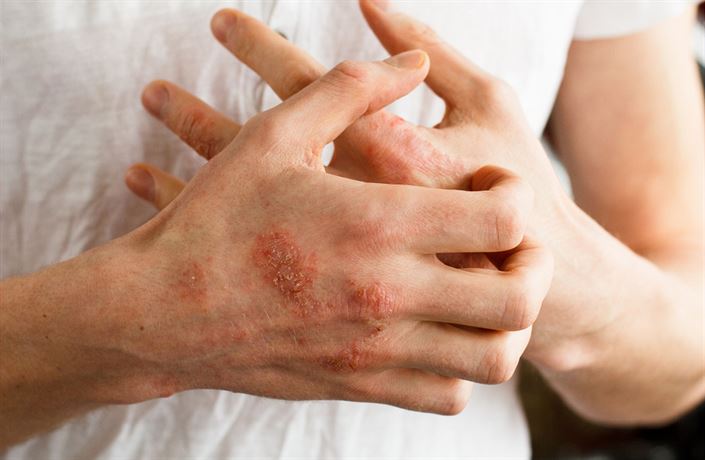 Poruchu kůže je těžké dobře určit | Zdraví | Lidovky.cz