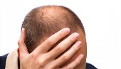 S plešatostí by mohl být konec, tvrdí američtí vědci