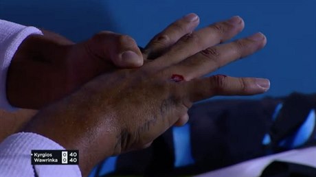 Zraněná ruka tenisty Nicka Kyrgiose.