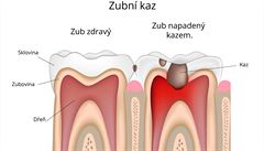 Zubní kaz.