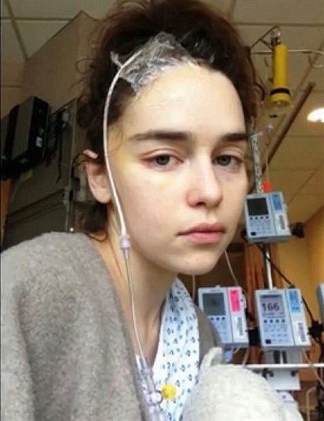 Emilia Clarkeová po operaci mozku v roce 2011.