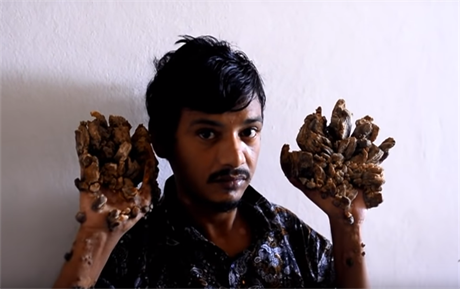 Bangladéský stromový mu chce amputaci rukou, bolí ho