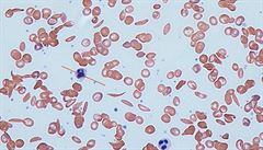 Pi srpkovité anémii se v krvi objevují abnormální protaené erytrocyty