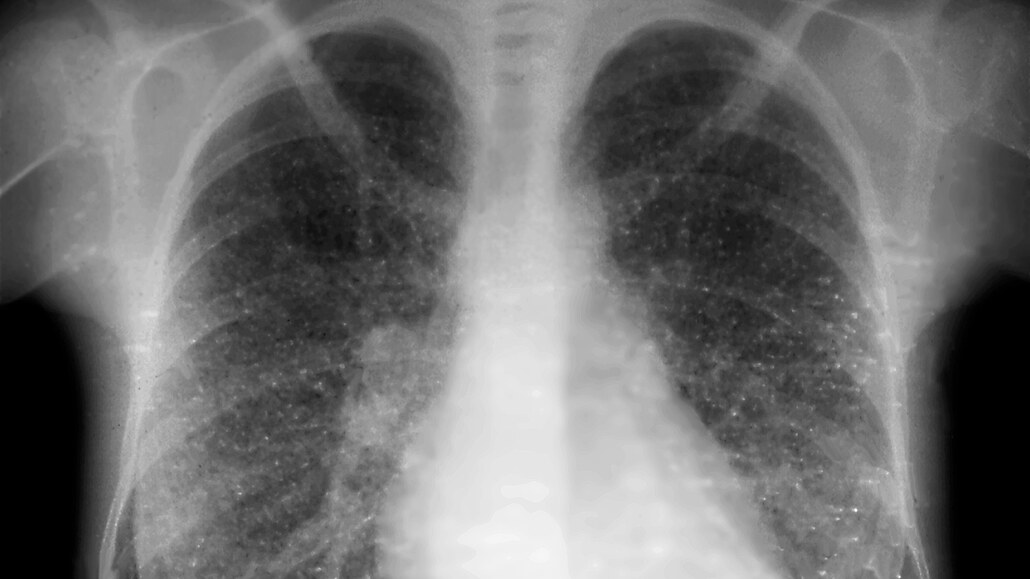 Tuberkulóza - ilustraní foto.