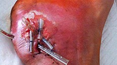 Zni�ená achillovka Petra Svobody, kv�li kterému mu hrozila amputace nohy.