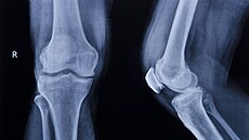 Voperovaný implantát podpoří růst nové chrupavky v koleni 