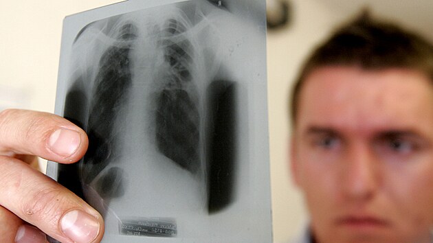 Léka se dívá na rentgen plic.