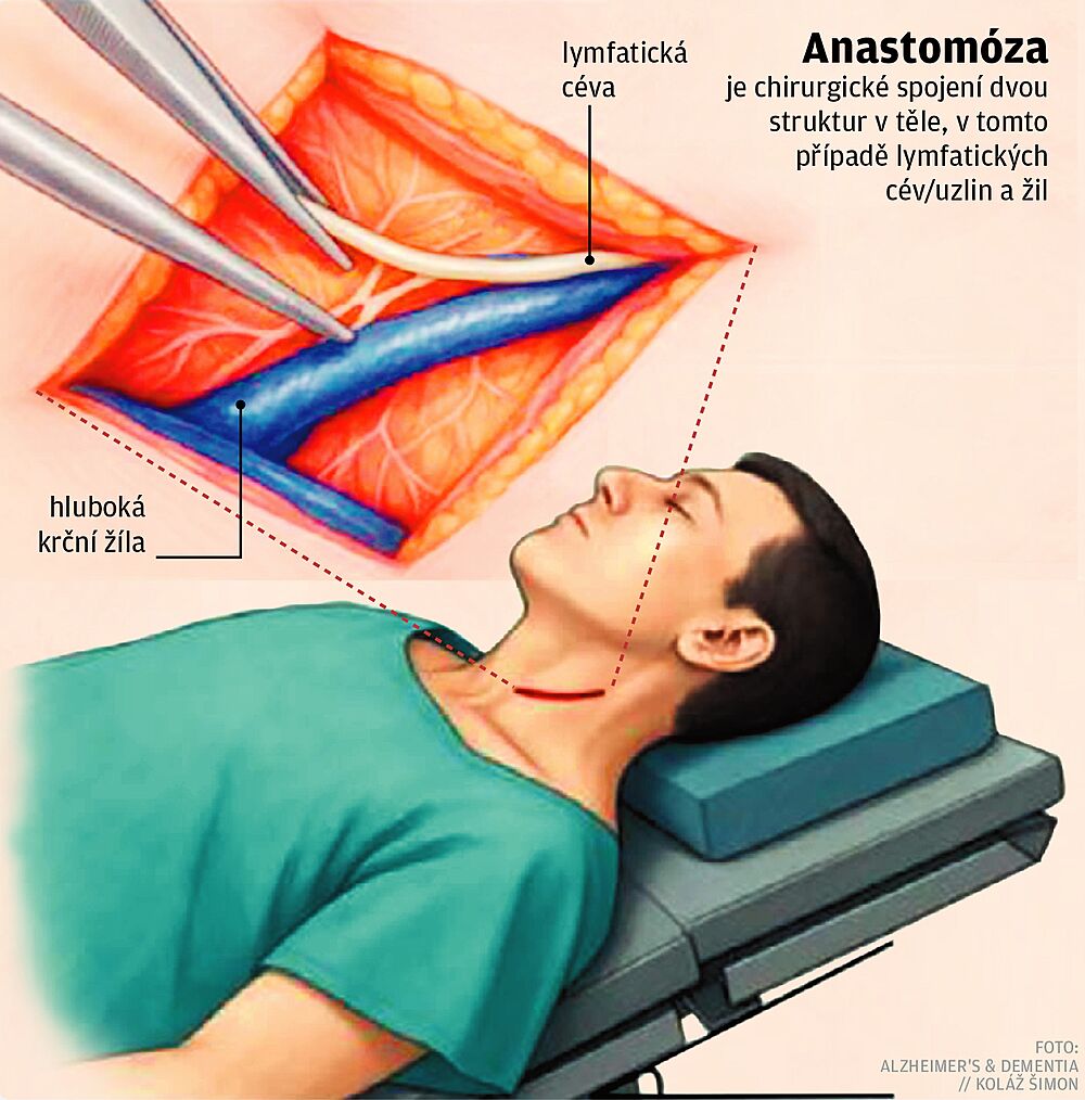 Anastomóza