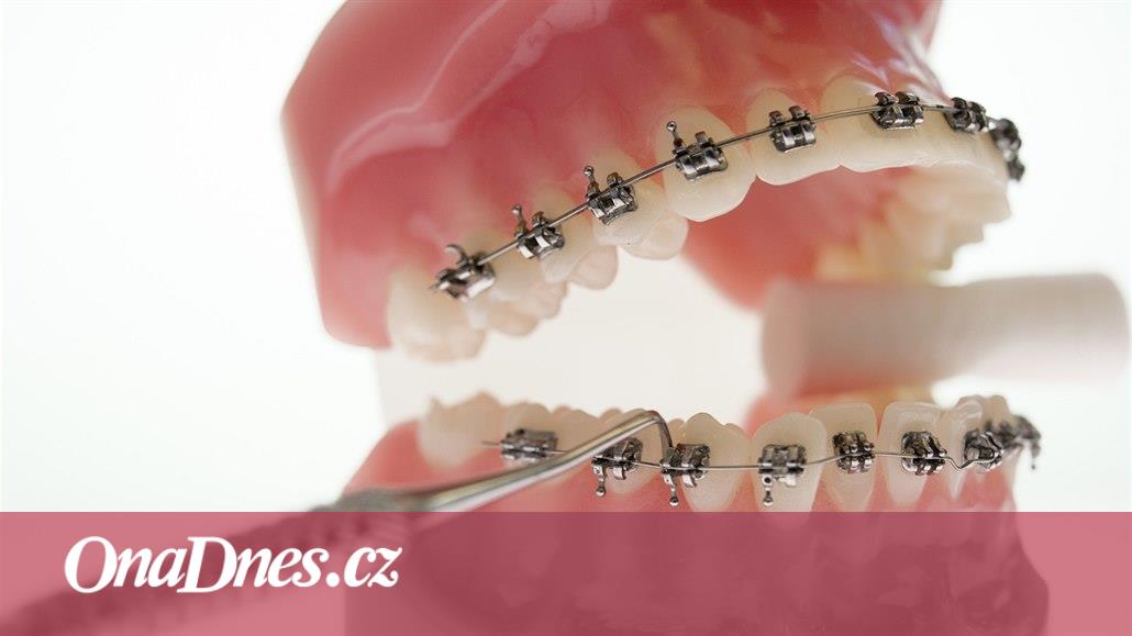 Zuby lze srovnat v každém věku, někdy je ale třeba začít už v dětství -  iDNES.cz