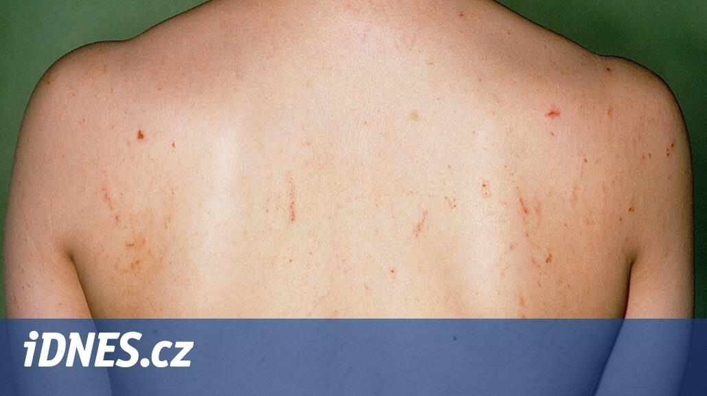 Scabies is spreading in the Czech Republic, and hygienists have noted a sharp increase in infections these six months