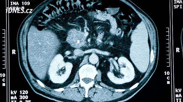 Cukrovka i rodinná historie. Nové prohlídky pomohou čelit rakovině slinivky