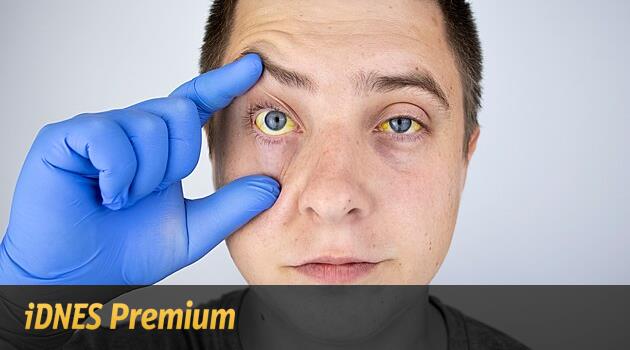 Žloutenka v Česku sílí, zájemce o očkování však lékaři musejí odmítat. Vakcíny došly