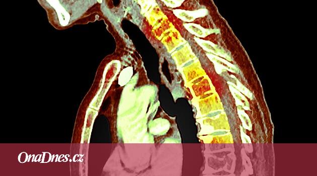 Zlomená žebra, únava a šokující diagnóza. Marie bojuje s mnohočetným myelomem