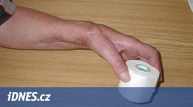 Prsty přišívají už 30 let, umí i skalp. Tým chirurgů zvládl přes 400 ...