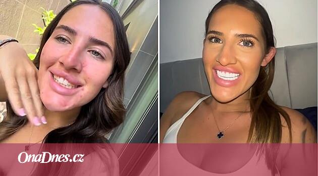 Žena chtěla dokonalý chrup. Dnes ho má a září do dálky