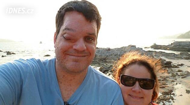 Děti se mu smály, že je Kyklop. Překonal šikanu i ztrátu oka, dnes šíří osvětu