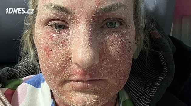 Alergie na krém byla pro ženu mučením, uvažovala o sebevraždě